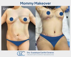 Mommy Makeover en TIjuana